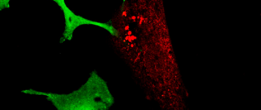 cancer neurons